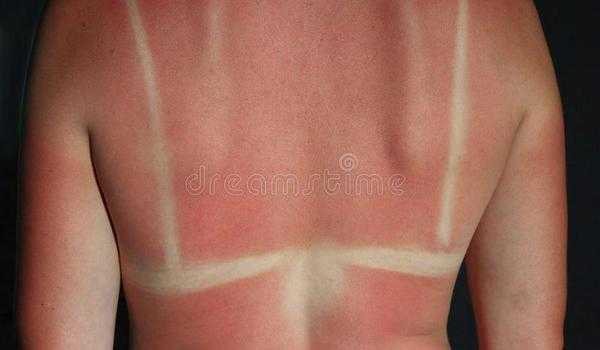 მზისგან მხოლოდ ერთი დამწვრობა  აორმაგებს კანის კიბოს რისკს